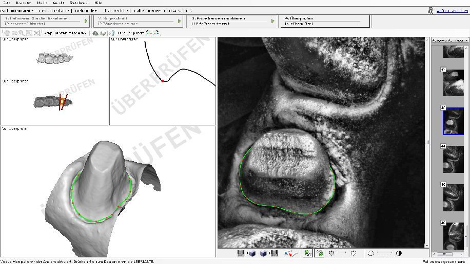 14866285-digitale-abformung Scanner Aufnahme Digitale Abformung